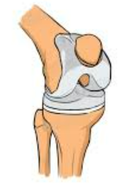 Knee Prosthesis 1